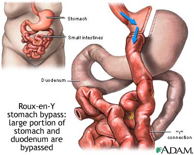 Roux-en-Y stomach surgery for weight loss