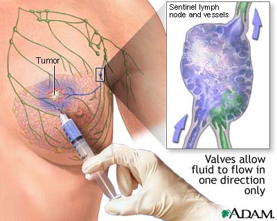 Sentinel node biopsy