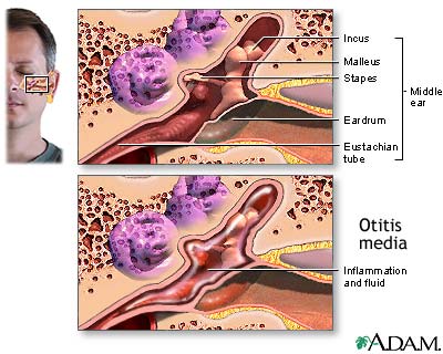 Middle ear infection (otitis media)