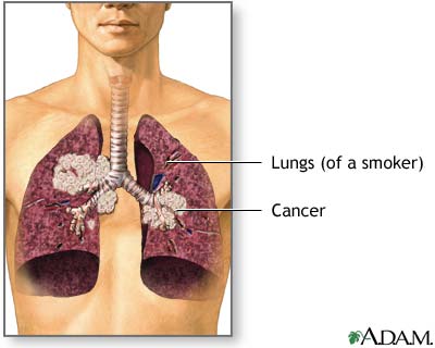 Secondhand smoke and lung cancer