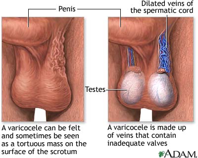 Varicocele