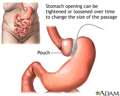 Adjustable gastric banding