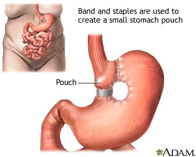 Vertical banded gastroplasty