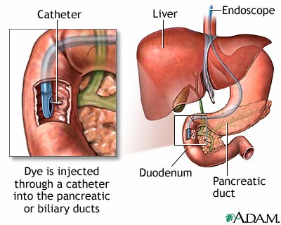 ERCP