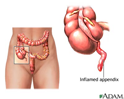 Appendicitis