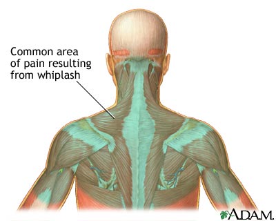 Location of whiplash pain