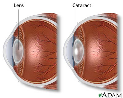 Cataract