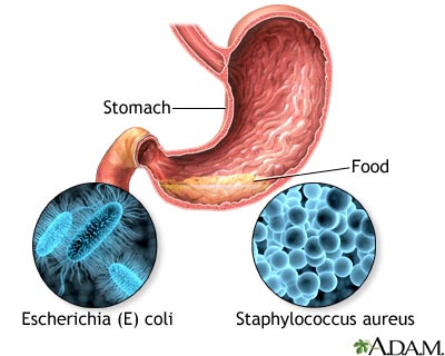 Food poisoning