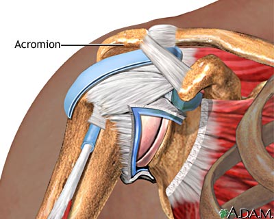 Impingement syndrome