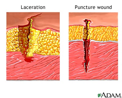 Laceration versus puncture wound