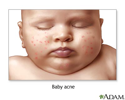 Baby acne