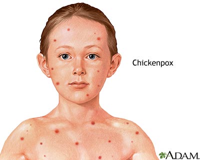 Chickenpox