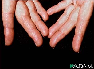 Amyloidosis on the fingers