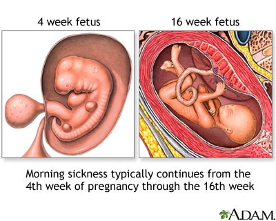 Morning sickness