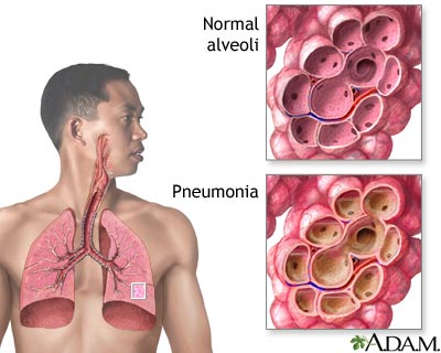 Pneumonia