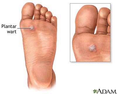 Plantar wart