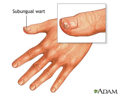 Subungual wart