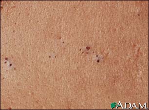 Blackheads (comedones)