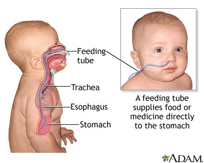 Feeding tube