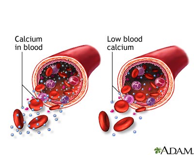 Hypocalcemia