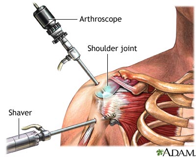 Shoulder arthroscopy