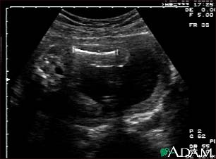 Ultrasound, normal fetus - femur measurement