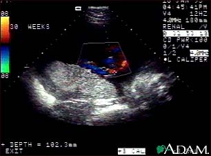 Ultrasound, color - normal umbilical cord