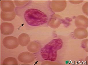 Mononucleosis, photomicrograph of cell