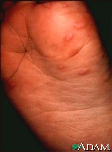 Hand, foot, and mouth disease on the foot