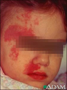 Port wine stain on a child's face