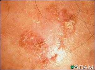 Actinic keratosis - close-up