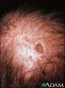 Actinic keratosis on the scalp