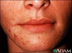 Dermatitis, perioral