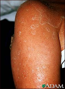 Exfoliation following erythroderma