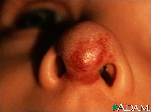 Hemangioma on the face (nose)