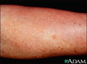 Mastocytosis, diffuse cutaneous