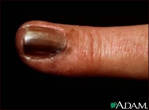 Skin cancer, melanoma on the fingernail