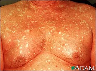 Pityriasis rubra pilaris on the chest