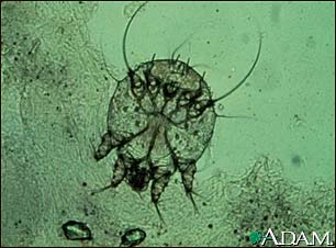 Scabies mite, photomicrograph