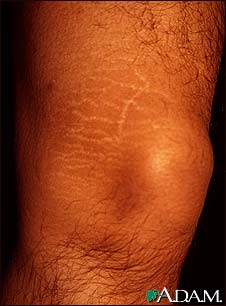 Striae on the leg