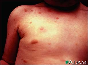 Urticaria pigmentosa on the chest