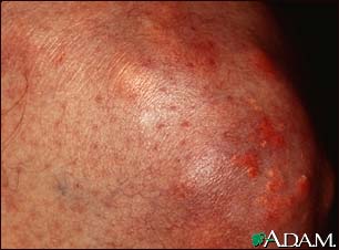 Xanthoma on the knee