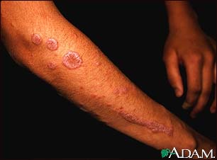 Lichen planus on the arm