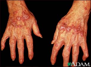 Lichen planus on the hands