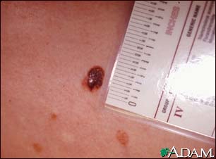 Skin cancer, close-up of level III melanoma