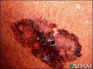 Skin cancer, melanoma superficial spreading