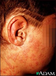 Psoriasis, guttate on the cheek