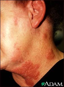 Herpes zoster (shingles) on the neck and cheek