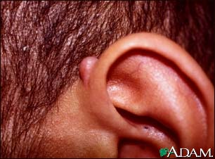 Keloid above the ear