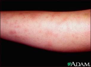 Erythema nodosum associated with sarcoidosis